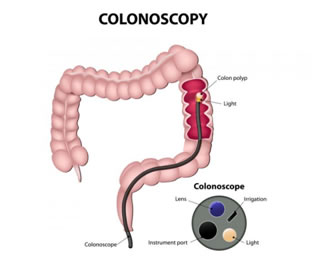 Colonoscopy